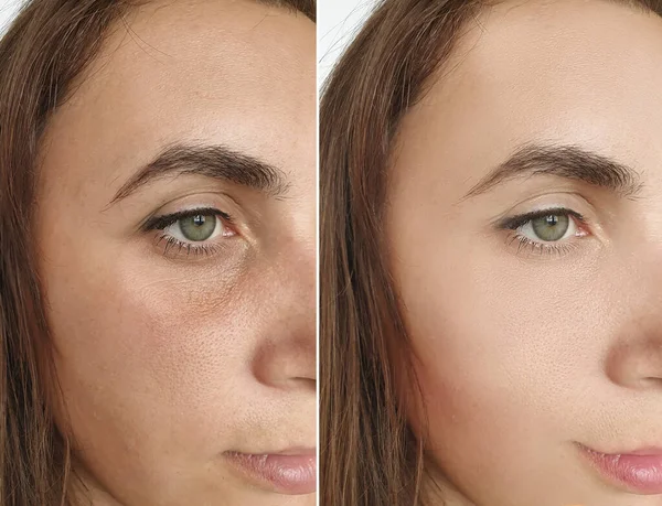Arrugas Cara Mujer Antes Después Del Tratamiento Collage — Foto de Stock
