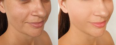 Kadın tedavi öncesi ve sonrası kırışıklıklarla karşılaşır.