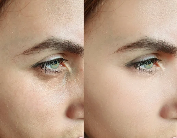 Arrugas Cara Mujer Antes Después Del Tratamiento Collage — Foto de Stock