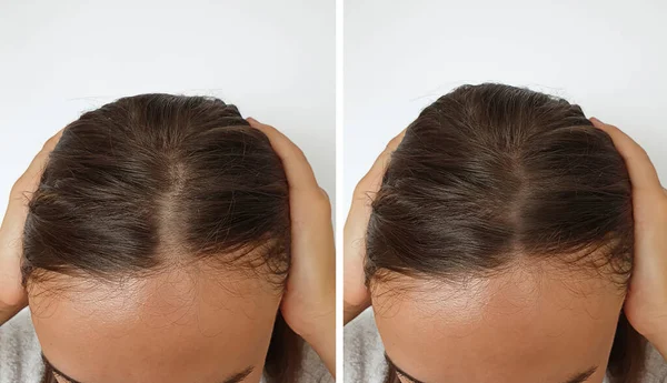 Łysienie Kobiety Włosy Przed Leczeniu — Zdjęcie stockowe