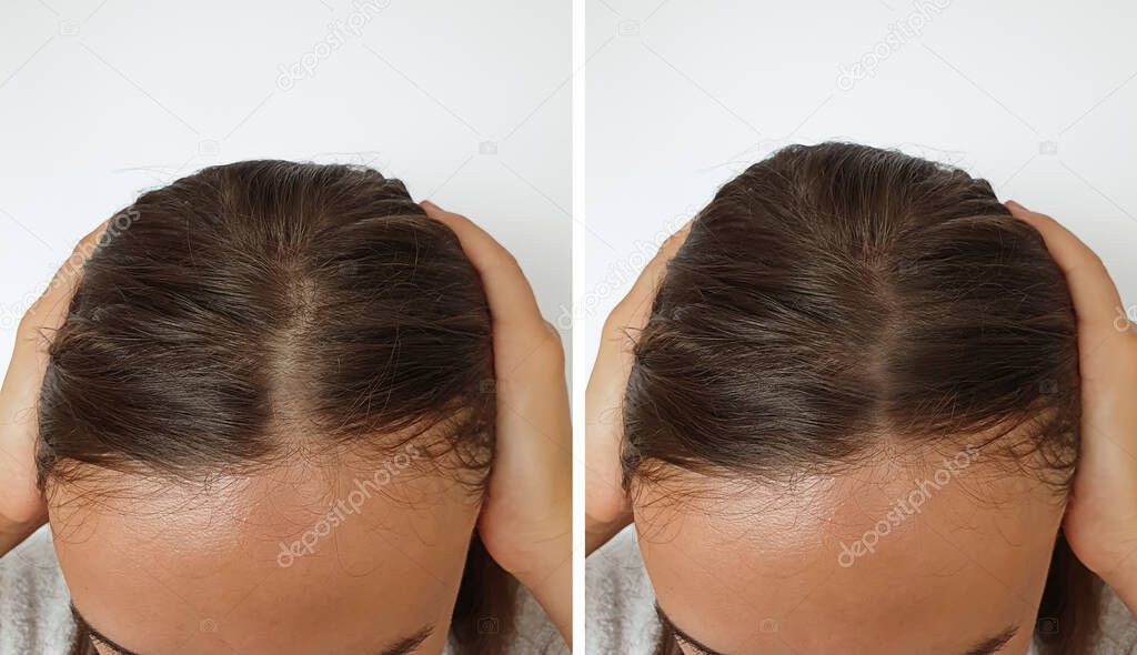 woman baldness hair before and after treatment