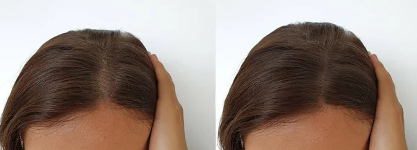 Tedavi Öncesi Sonrası Kel Kadın Saçı — Stok fotoğraf