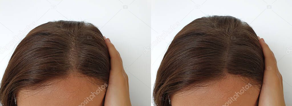 woman baldness hair before and after treatment