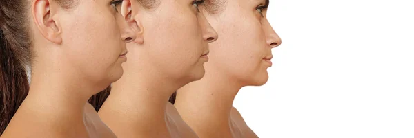 Woman Double Chin Treatment — Stock Photo, Image