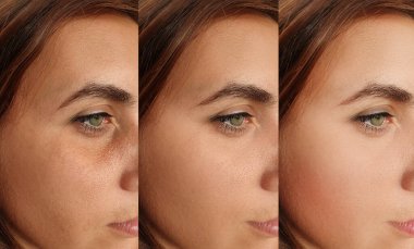 Kadın tedavi öncesi ve sonrası kırışıklıklarla karşılaşır.