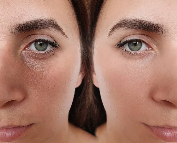 Arrugas Cara Mujer Antes Después Del Tratamiento Collage — Foto de Stock