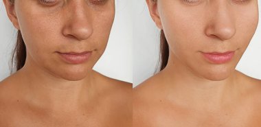 Kadın tedavi öncesi ve sonrası kırışıklıklarla karşılaşır.