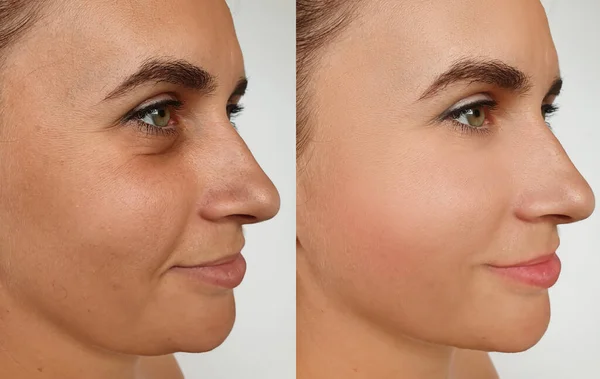 woman face wrinkles before and after treatment collage