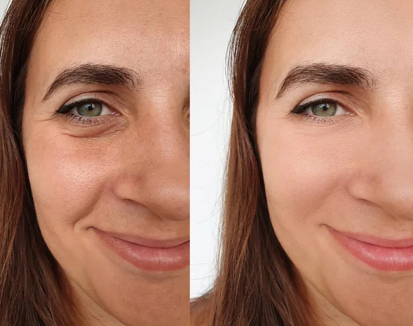 Rugas Cara Mulher Antes Após Colagem Tratamento — Fotografia de Stock