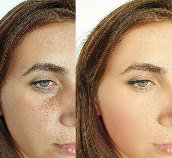 Wanita Wajah Keriput Sebelum Dan Setelah Perawatan Kolase — Stok Foto
