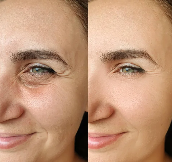 Arrugas Cara Mujer Antes Después Del Tratamiento Collage — Foto de Stock