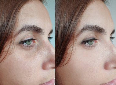 Kadın tedavi öncesi ve sonrası kırışıklıklarla karşılaşır.