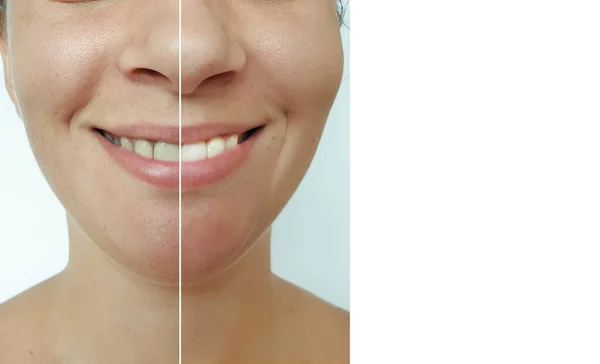 Mulher Sorridente Antes Depois Procedimento Clareamento Dos Dentes — Fotografia de Stock