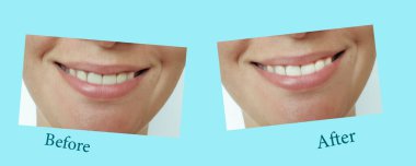 Gülümseyen kadın diş beyazlatma prosedüründen önce ve sonra