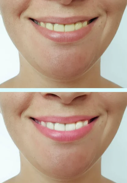 Mulher Sorridente Antes Depois Procedimento Clareamento Dos Dentes — Fotografia de Stock