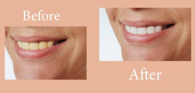 Gülümseyen kadın diş beyazlatma prosedüründen önce ve sonra