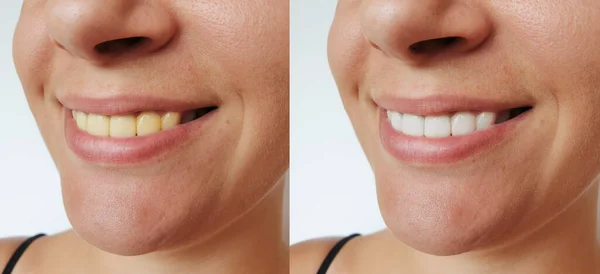 Mulher Sorridente Antes Depois Procedimento Clareamento Dos Dentes — Fotografia de Stock