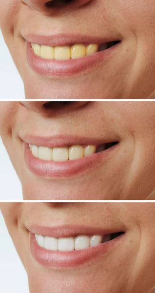 Посміхається Жінка Після Процедури Відбілювання Зубів — стокове фото
