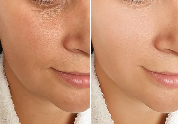 Arrugas Cara Mujer Antes Después Del Tratamiento Collage — Foto de Stock