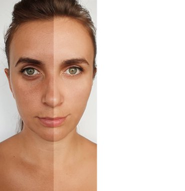 Kadın tedavi öncesi ve sonrası kırışıklıklarla karşılaşır.