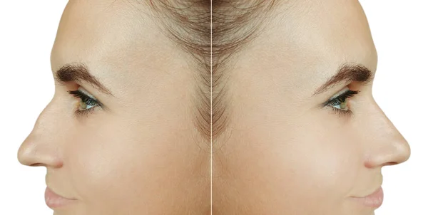 Junge Frau Vor Und Nach Nasenkorrektur Auf Weißem Hintergrund — Stockfoto