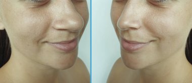 Kadın tedaviden önce ve sonra burun sürtünmesi