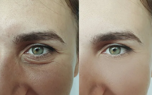 Wanita Wajah Keriput Sebelum Dan Setelah Perawatan Kolase — Stok Foto