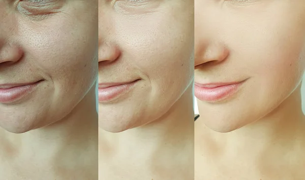 Woman Face Wrinkles Treatment Collage — Stock Photo, Image