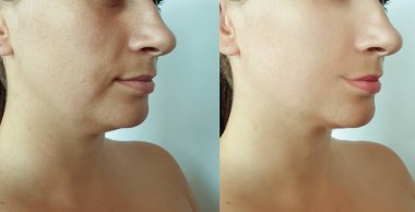 Kadın tedaviden önce ve sonra kırışıklıklarla karşılaşır.