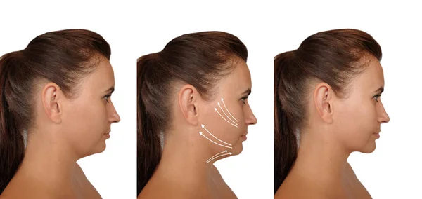 Woman Face Wrinkles Treatment Double Chin — Stock Photo, Image