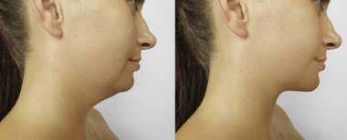 Kadın tedaviden önce ve sonra kırışıklıklarla karşılaşır.