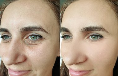 Kadın tedavi öncesi ve sonrası kırışıklıklarla karşılaşır.