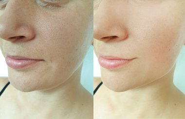 Kadın tedaviden önce ve sonra kırışıklıklarla karşılaşır