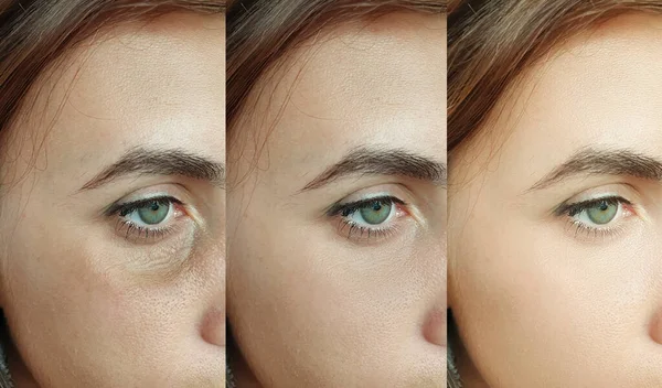 Frauengesichtsfalten Vor Und Nach Der Behandlung Collage — Stockfoto
