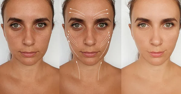 Woman Face Wrinkles Treatment Collage — Stock Photo, Image