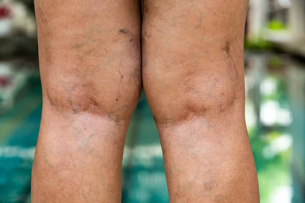 Varices Arrière Des Genoux Des Jambes Chez Femme Âgée — Photo