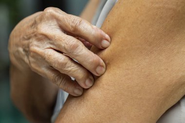 Senior Woman sağ elini sol kolunu kaşıyarak, Mavi yüzme havuzu arka plan, Çekim kadar kapat, Asya Vücut cilt parçası, Sağlık kavramı