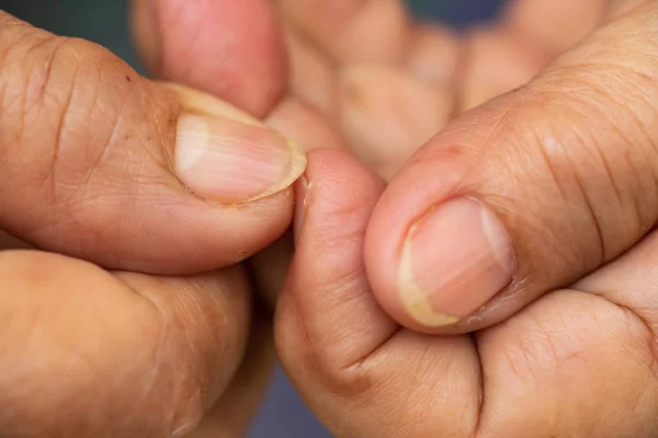 Senior woman nibbling  her nails, Close up & Macro shot, Selective focus, Asian body skin part, Healthcare concept — Stock Photo, Image