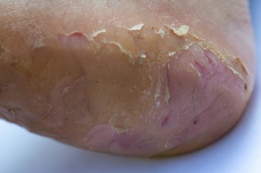 Kadının topuk molası ve soyma, ayak Dermatit, Beyaz arka plan, Yakın ve makro çekim, Seçici odak, Asya Vücut cilt parçası, Sağlık kavramı