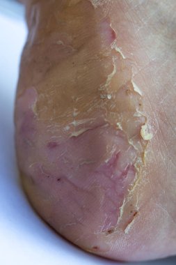 Kadının topuk molası ve soyma, ayak Dermatit, Beyaz arka plan, Yakın ve makro çekim, Seçici odak, Asya Vücut cilt parçası, Sağlık kavramı