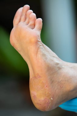 Kadının topuk molası ve soyma, ayak Dermatit, Yakın ve makro çekim, Seçici odak, Asya Vücut cilt parçası, Sağlık kavramı