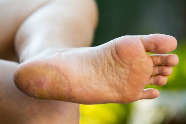 Kadın topuk molası ve soyma, ayak Dermatit, Yeşil bahçe arka plan, Yakın ve makro çekim, Seçici odak, Asya Vücut cilt parçası, Sağlık kavramı