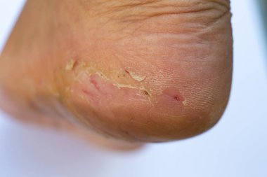 Kadının topuk molası ve soyma, ayak Dermatit, Beyaz arka plan, Yakın ve makro çekim, Seçici odak, Asya Vücut cilt parçası, Sağlık kavramı