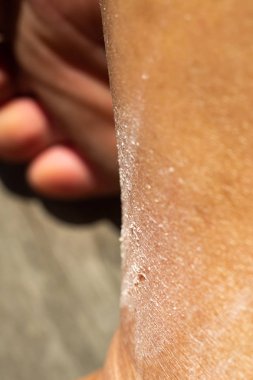 Bacakta kadının çizik ve kuru cilt, Close up & Macro shot, Asya Vücut cilt parçası, Sağlık kavramı, Soyut arka plan