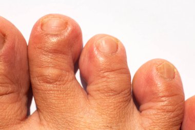 Kadınların çarpık ikinci adabı, orta ada, dördüncü ada, Beyaz arka planda kuru cilt, Close up & Macro çekim, Asya Vücut cilt parçası, Sağlık kavramı