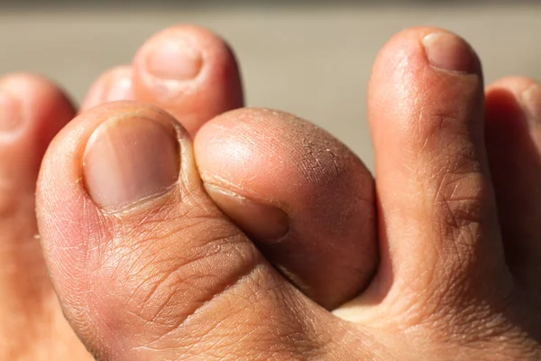 Dedos cruzados das mulheres, dedo grande seco e sujo, Close up & Macro tiro, parte da pele do corpo asiático, conceito de cuidados de saúde — Fotografia de Stock