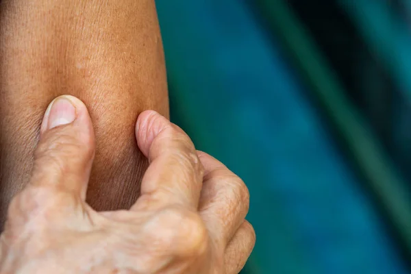 Senior Woman's right hand scratching her left  arm, Blue swimming pool background, Close up shot, Asian Body skin part, Healthcare concept