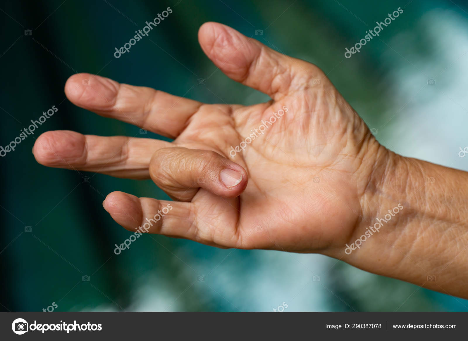 Trigger Finger lock on ring finger of senior woman's right hand