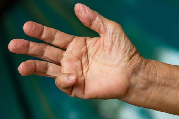Захват пальца триггера на мизинец правой руки пожилой женщины, страдание от боли, плавательный бассейн фон, концепция здравоохранения — стоковое фото