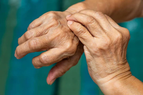 Senior vrouw linkerhand krassen haar rechterhand, blauwe zwembad achtergrond, close-up shot, Aziatische lichaam huid deel, gezondheidszorg concept — Stockfoto